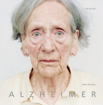 Alzheimer